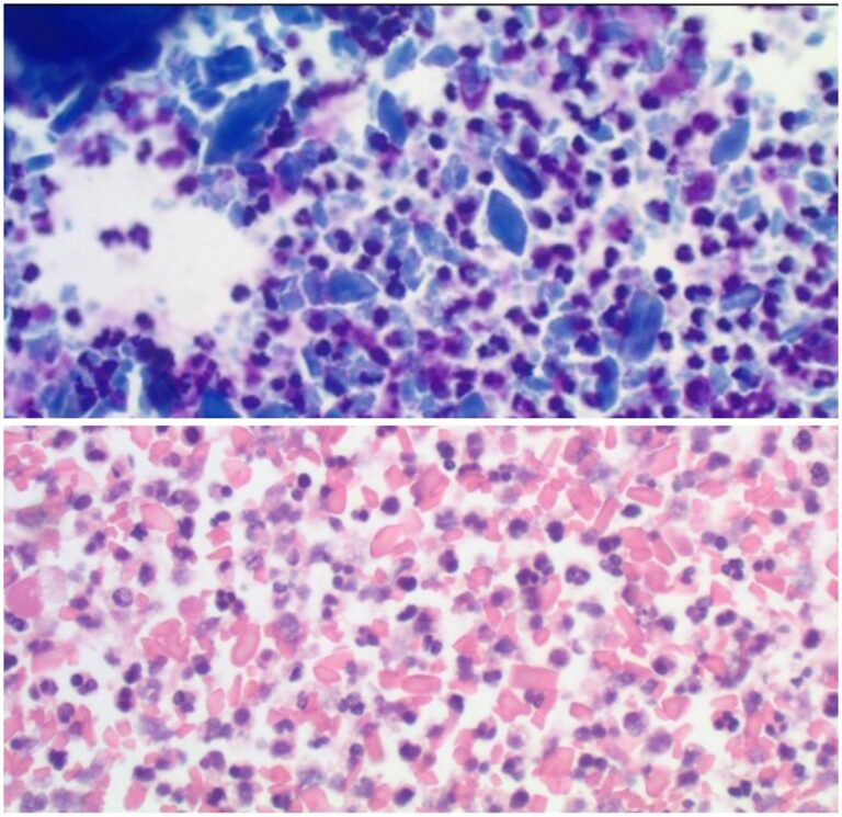 Two images of cells under a microscope, with the top image showing a higher density of purple-stained cells, suggesting a possible hematological condition, while the bottom image shows pink and purple stained cells, indicating a different or less severe state.